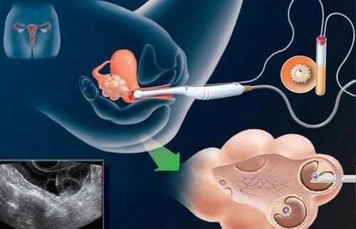 供卵价钱表:三代试管婴儿价格越贵成功率就越高吗?